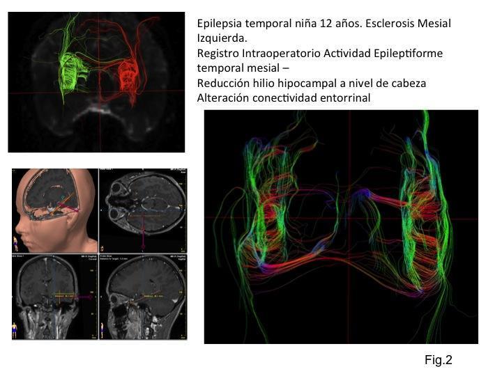 Esclerosis mesial en epilepsia temporal